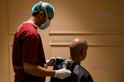 Przeszczepy włosów u mężczyzny w Indiach