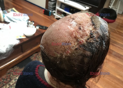 Dzięki fryzjerowi dowiedziała się, że narośl we włosach to nowotwór