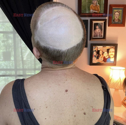 Dzięki fryzjerowi dowiedziała się, że narośl we włosach to nowotwór