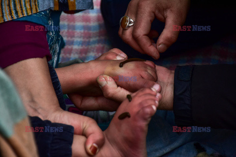 Tradycyjne leczenie pijawkami w Kaszmirze