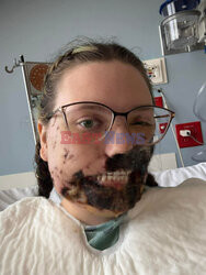 Pies pogryzł jej twarz gdy miała atak padaczki