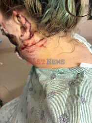 Pies pogryzł jej twarz gdy miała atak padaczki