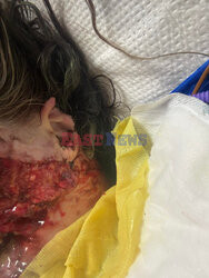 Pies pogryzł jej twarz gdy miała atak padaczki