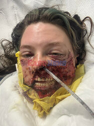 Pies pogryzł jej twarz gdy miała atak padaczki