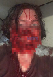 Pies pogryzł jej twarz gdy miała atak padaczki