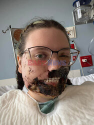 Pies pogryzł jej twarz gdy miała atak padaczki