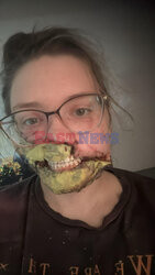 Pies pogryzł jej twarz gdy miała atak padaczki