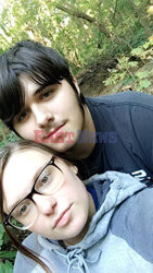 Pies pogryzł jej twarz gdy miała atak padaczki